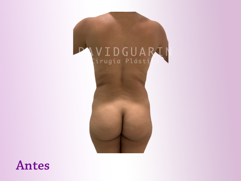 mastopexia
