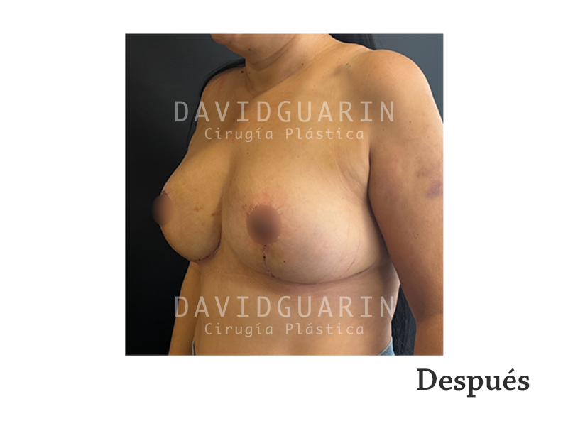 Retiro de implantes mamarios